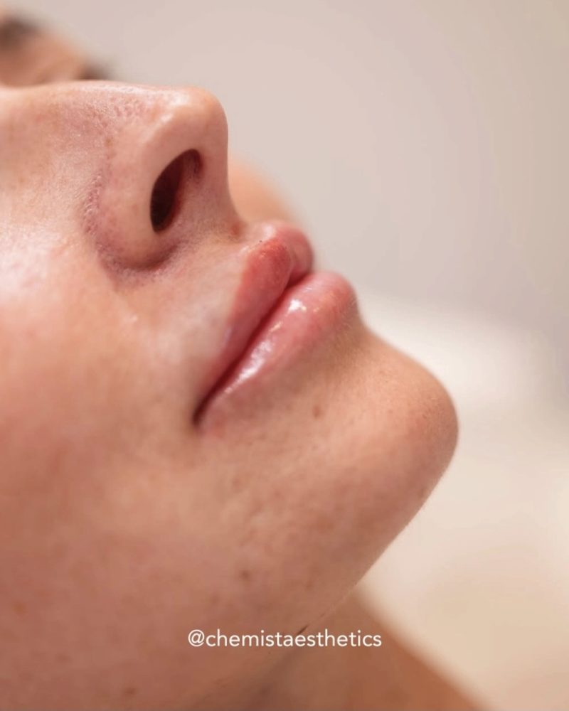 Anti-Wrinkle Injections treatment at Chemist Aesthetics, Liverpool
